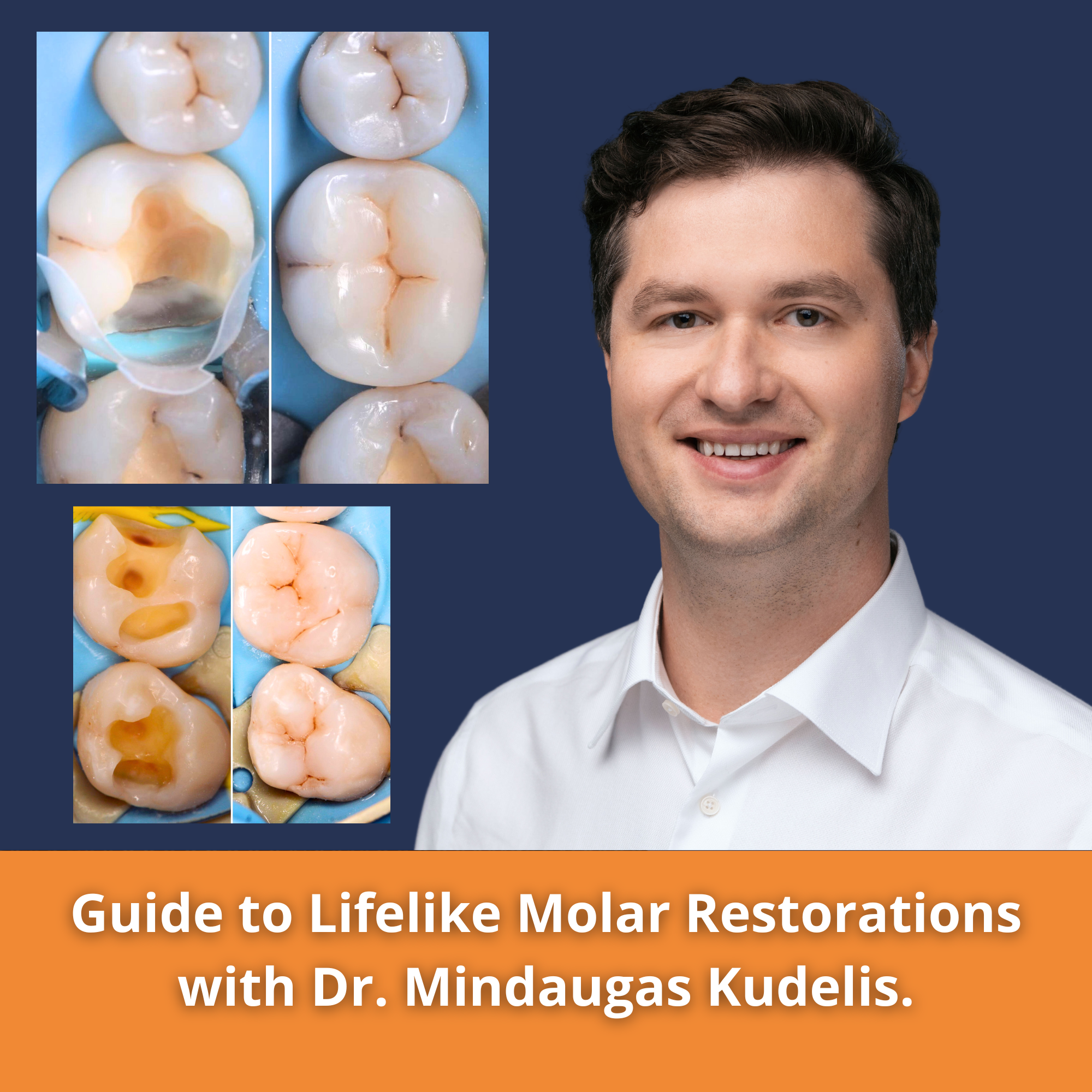 A Guide to Lifelike Molar Restorations with Dr. Mindaugas Kudelis.
